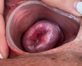 Small cervix without dilating